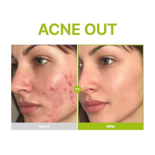 Purito SEOUL - Azelaic Acid 10 Kojic Tea Tree Serum - 30ml