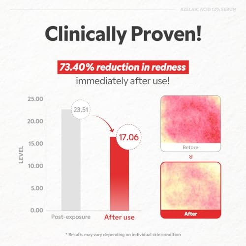 TIRTIR Azelaic Acid 12% Serum for Blemish-Prone Skin - Lightweight Hydrating Formula with Zinc PCA & Hyal-ZIP, Non-Comedogenic, Fragrance-Free, 30ml /